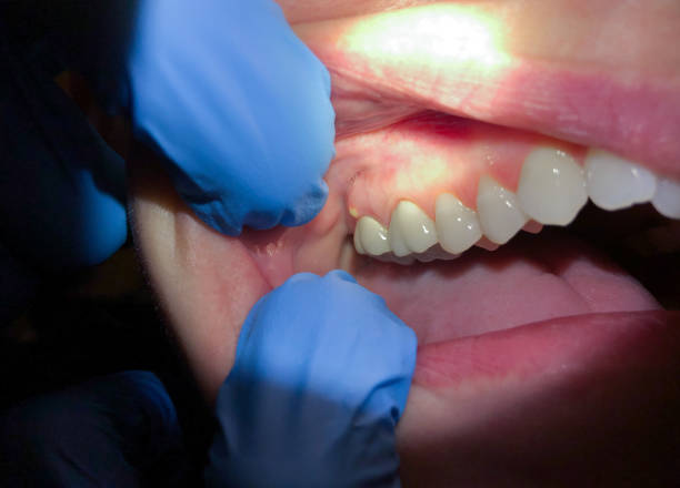 Best Chipped Tooth Repair Near Me  in South Vacherie, LA
